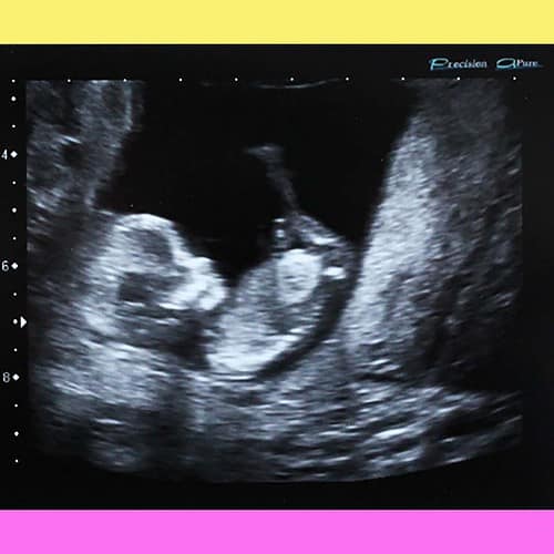 Baby Leelalicious Sonogram Picture