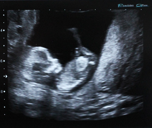 Baby Sonogram Picture